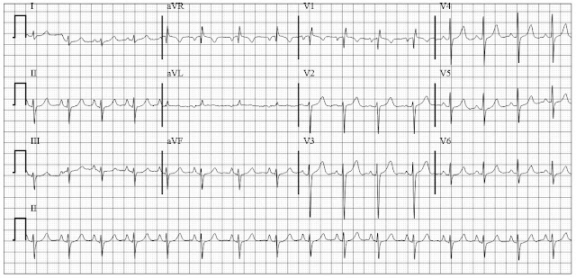 ECG of a patient with chronic bronchitis