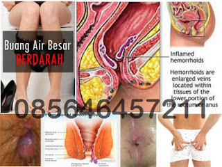 Harga Obat Untuk Mengobati Wasir Bengkak