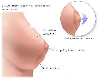  Fibroadenoma ialah benjolan padat yang kecil dan jinak pada payudara yang teridiri dari  Fibroadenoma : benjolan pada payudara