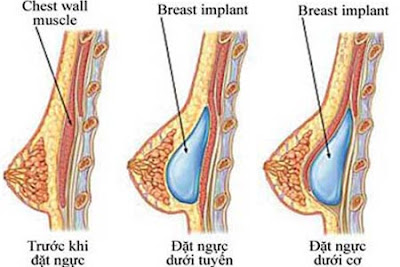 Nâng ngực có ảnh hưởng đến sinh con không 2