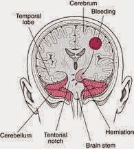 http://jayao77.blogspot.com/2014/11/askep-trauma-kepala.html