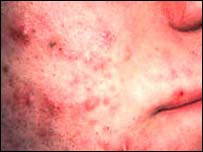 Stress Causes Cystic Acne