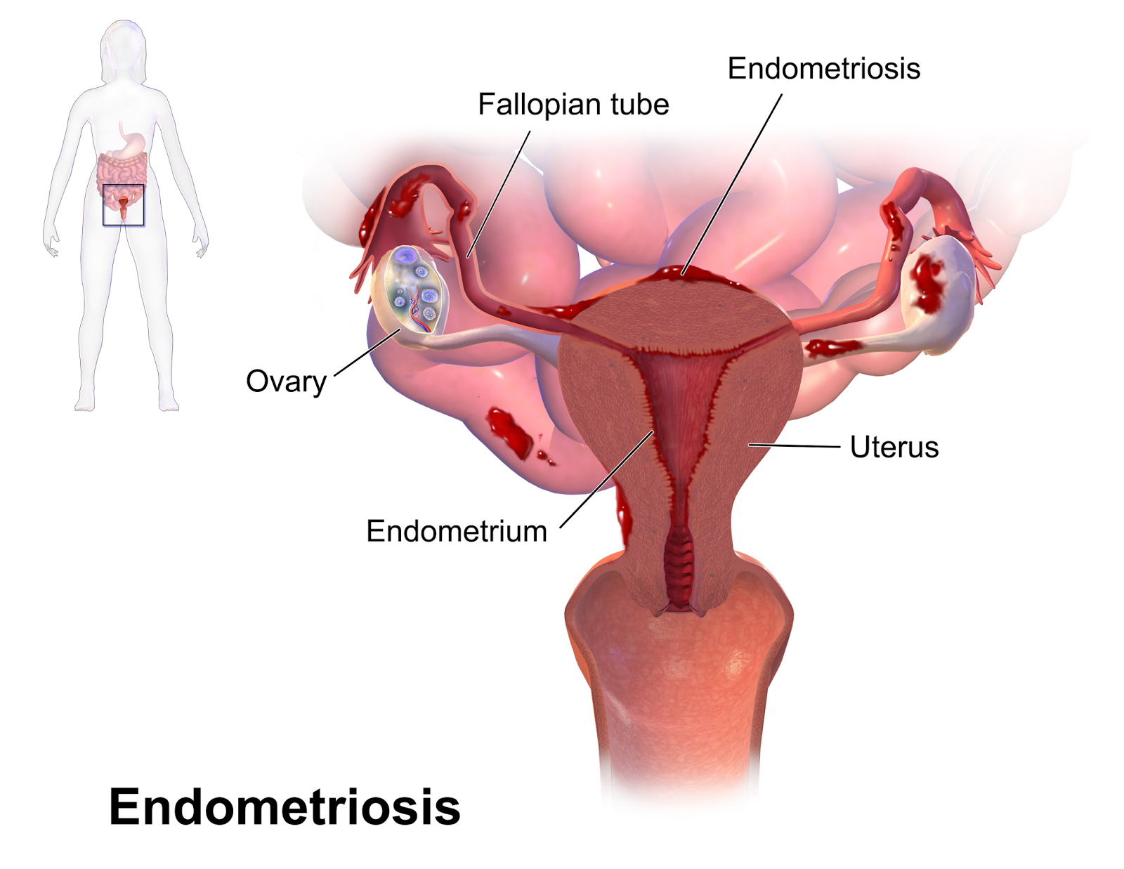  கருப்பை உட்சுவர் சவ்வு அழற்சி - Endometriosis கருப்பையின் உட்சுவர் சவ்வு, சில சமயங்களில் கருப்பைக்கு வெளியேயும் வளர ஆரம்பிக்கும். இப்பிரச்சனையைத்தான் நாம் கருப்பை உட்சுவர் சவ்வு அழற்சி (Endometriosis) என்கிறோம். கருத்தரித்தலை வெகு நாட்களுக்கு செயற்கையாகத் தள்ளிப் போடும் பெண்கள், நீண்ட நாட்களுக்குப் பிறகு கருவுறும் போது இப்பிரச்சனை ஏற்படுகிறது. அதனால் தான் இந்நோயை பணிக்குச் செல்லும் பெண்களின் நோய் (Career Woman’s Diseases) என்று அழைக்கிறார்கள்.  கருப்பை உட்சுவர் சவ்வு ஒவ்வொரு மாதவிடாய்ச் சுழற்சியின் போதும் சுரக்கும் ஈஸ்ட்ரோஜன் (Oestrogen) மற்றும் புரொஜஸ்டிரான் (Progesterone)  ஆகிய ஹார்மோன்களின் அளவைப் பொருத்தே கருப்பைக்குள் வளருகிறது. இந்த ஹார்மோன்கள் அதிகமாக சுரக்கும் போது, இவை நன்கு வளர்ந்துப் பருத்துப் படருகின்றன. ஹார்மோன்களின் சுரப்பு குறையும் பொழுது, இவை கட்டிக் கட்டியாகக் கழன்று மாதவிடாயுடன் சேர்ந்து வெளியேறுகின்றன. ஆனால், கருப்பைக்கு வெளியே வளர்ந்த கருப்பை உட்சுவர்த் திசுக்கள் சரியானபடி வெளியேறப்பாதை இல்லாததால் அவை வயிற்றுக்குள்ளேயே தங்கி, ஒன்றன் மீது ஒன்றாகக் கெட்டியாக ஒட்டி வளருகின்றன. இதைத் தான் நாம் கருப்பை உட்சுவர் சவ்வு அழற்சி என்கிறோம்.  கருப்பைக்கு வெளியே வளர்ந்த உட்சுவர்த்திசுக்கள் சில சமயங்களில் சினைப்பைகளை பாதித்து, கருப்பை உட்சுவர் சவ்வுக்கட்டிகளாக மாறிவிடக்கூடும். காலப்போக்கில் இவை கறுத்துச் சிவந்த பழுப்பு நிறமாக மாறக்கூடும். இவ்வாறு மாறிய இந்தக் கட்டிகளை சாக்லெட் கட்டிகள் Chocolate Cyst என்று அழைக்கிறோம். இவை பட்டாணியைப் போன்று சிறிதாகவோ அல்லது திராட்சைப் பழத்தைப் போல பெரிதாகவோ இருக்கலாம்.  கருப்பை உட்சுவர் சவ்வு அழற்சியின் காரணமாக, மாதவிடாயின் போது வலியும், வேதனையும் அதிகமாக ஏற்படும். இதற்குக் காரணம் கருப்பை உட்சுவர் திசுக்களிலிருந்து வெளியாகும் புரோஸ்டோகிளாண்டின்ஸ் Prostoglandines என்ற ஹார்மோனாகும். இந்த ஹார்மோன் கருப்பையின் தசைகளை இறுக்குவதே வலி ஏற்பட காரணமாகிறது. கருப்பை உட்சுவர் சவ்வு அழற்சி எந்த அளவுக்கு பரவியுள்ளது என்பதைப் பொருத்து இந்த வலியும், வேதனையும் அதிகரிக்கிறது. சிலருக்கு மாதவிடாய் ஏற்படுவதற்கு முன்பும் கூட வலி உண்டாகலாம். மேலும் உடலுறவின் போதும் கூட சிலருக்கு வலி ஏற்படும். இதை புணர்வலி Dysparunia  என்பார்கள். சினைப்பைகளையும், பிறப்புப் பாதையின் மேல் புறத்தையும், சுற்றி வளைத்துள்ள கருப்பை உட்சுவர் திசுக்களின் முடிச்சுக்கள் ஆணுறுப்பு உள்ளே செலுத்தப்படும் பொழுது ஏற்படும் அசைவினால் (Sexual Intercourse) பாதிக்கப்பட்டு வலி (Dyspareunia) ஏற்படுகிறது.  இந்நோயால் பாதிக்கப்பட்ட பெண்களில் பலருக்கு மாதவிடாய்ச் சுழற்சியில் எந்த பாதிப்பும் ஏற்படுவதில்லை. ஒரு சிலருக்கு சீரான இடைவெளி இல்லாமல் பிறப்புப் பாதை வழியே இரத்தம் கசியும். மேலும், சிலருக்கு மாதவிடாய் ஆரம்பிக்கும் முன்னர் இரத்தம் சொட்டுச் சொட்டாக (Oligomenorrhoea)  வெளியேறும்.  இந்நோயால் பாதிக்கப்பட்ட பெண்களில் சிலருக்கு, கருத்தரிக்க இயலாமைக்கு வேறு காரணங்களும் இருக்கக்கூடும். அதில் ஒன்று, விந்தணுவின் தரம் மோசமடைந்து இருப்பதாகும். சிலருக்கு கரு முட்டை வெளிப்படுவதில் பிரச்சனைகள் ஏற்படலாம். கருமுட்டை வெளிப்பட்டாலும், கருக்குழாயின் நார்மருவிகளால் கருமுட்டையைத் தனக்குள் கவர்ந்திழுக்கும் ஆற்றல் குறைந்திருக்கலாம் அல்லது கருக்குழாயில் அடைப்பு ஏற்பட்டிருக்கலாம். சினைப்பையில் சாக்லெட் கட்டிகள் இருந்தாலும் கருமுட்டை வெளிப்படுவதில் தடை ஏற்படும்.  பரிசோதனைகள் (Investigations) கருத்தரிக்க இயலாத பெண்கள் தமக்கு மாதவிடாய் ஏற்படும் பொழுது, அதிக வலியால் வேதனைப்படுவதாகக் கூறும் பொழுது அல்லது உடலுறவின் போது அதிக வலி ஏற்படுகிறது என்று கூறும் பொழுது, அவர்களுக்கு கருப்பை உட்சுவர் சவ்வு அழற்சி ஏற்பட்டுள்ளது என சந்தேகிக்கலாம். ஆனாலும், லேப்ராஸ்கோப்பி பரிசோதனை மூலம் மட்டுமே நோயை உறுதி செய்ய முடியும்.  ஹோமியோபதி மருத்துவம் நோயின் அறிகுறிகளுக்கேற்ற ஹோமியோபதி மருந்துகள் நல்ல பலனைத்தரும்.     சிகிச்சைக்கு தொடர்பு கொள்ளவும் சிறப்பு மருத்துவர் செந்தில் குமார் தண்டபாணி அவர்களிடம் இதைப்போன்ற பிரச்சினைகளுக்கு அலோசனை &  சிகிச்சை பெற்று பலர் நல்ல பலனடைந்திருக்கிறார்கள். மருத்துவர் செந்தில் குமார் அவர்களை சென்னை, வேளச்சேரி விவேகானந்தா ஹோமியோபதி கிளினிக் & உளவியல் ஆலோசனை மையத்தில் சந்திக்கலாம். முன்பதிவு அவசியம். முன்பதிவிற்கு தொடர்புகொள்ளவும் 9786901830, மின் அஞ்சல்: consult.ur.dr@gmail.com    மேலும் விபரங்களுக்கும் ஆலோசனைக்கும் சிகிச்சைக்கும் தொடர்பு கொள்க விவேகானந்தா கிளினிக் ஆலோசனை மையங்கள் & தொடர்பு எண்கள் சென்னை:- 9786901830  பண்ருட்டி:- 9443054168  புதுச்சேரி:- 9865212055 (Camp) மின் அஞ்சல் : consult.ur.dr@gmail.com, homoeokumar@gmail.com   முன்பதிவிற்கு அழைக்கவும் அல்லது மின் அஞ்சல் அனுப்பவும்.  முன்பதிவிற்கு: உங்களின் பெயர் - வயது – அலைபேசி எண் – பிரச்சனை (ஒரு வரியில்) தேதி – கிழமை – இடம், முதலியவற்றை குறுந்தகவல் மூலம் அனுப்பவும். உதாரணம்: ரம்யா - 28 – 99******00 – குழந்தையின்மை – 20-12-2013 – சனிக்கிழமை – சென்னை, மருத்துவர் உங்களின் முன்பதிவை குறுந்தகவல் மூலம் உறுதிப்படுத்துவார்.