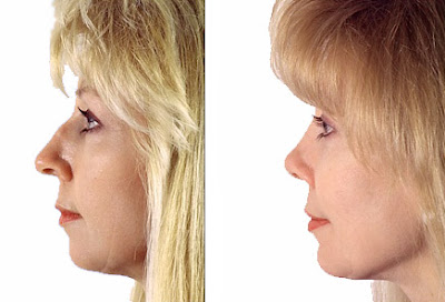 Chin Augmentation Before And After Photo