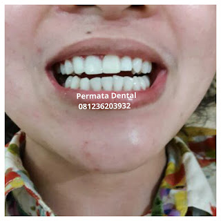 gambar foto contoh sebelum dan sesudah veneer gigi kelinci buatan manis cantik bali jember banyuwangi murah berkualitas di PERMATA DENTAL gambar gigi rusak yang di veneer gigi yang tidak rapi gigi renggang gigi patah cuil rompal pendek karies hitam kuning