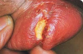 Obat Sifilis Resep Dokter