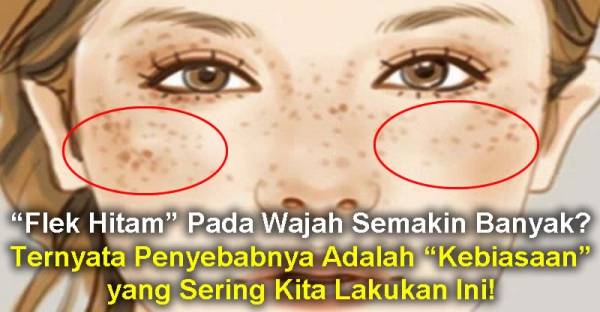 “Flek Hitam” Pada Wajah Semakin Banyak? Ternyata Penyebabnya Adalah “Kebiasaan” yang Sering Kita Lakukan Ini!