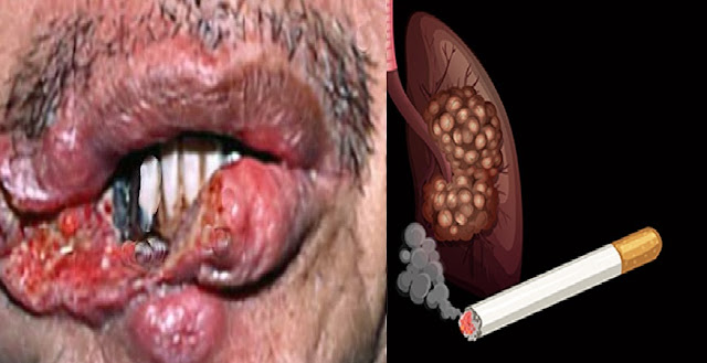 Mouth and Lung Cancer