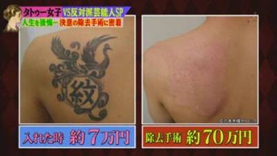 Cirurgia para remover tatuagem a Laser Fotos Antes e Depois