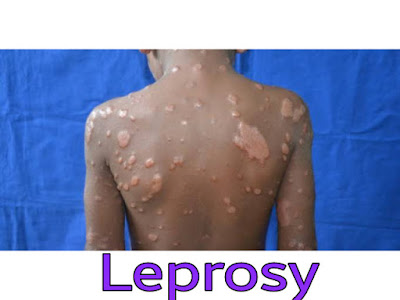 Leprosy disease diagram
