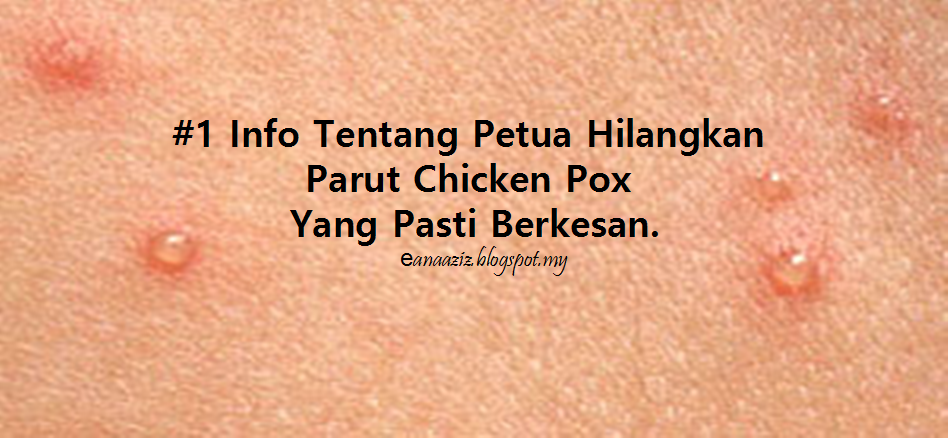 Ubat Untuk Parut Chicken Pox - Perubatan c