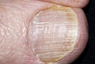 عندما تصرخ أقدامنا الشتاء!!!! princ_rm_photo_of_infected_toenail.jpg