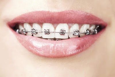 Công nghệ niềng răng khểnh giá bao nhiêu tiền?