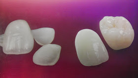 Bellevue Dentist | Porcelain Crowns | Porcelain Veneers