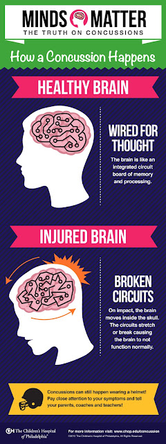 Concussions and concussion symptoms