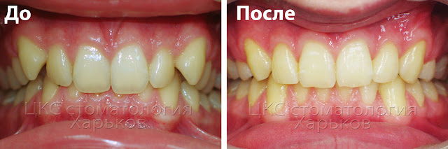 прикус до и после лечения брекетами