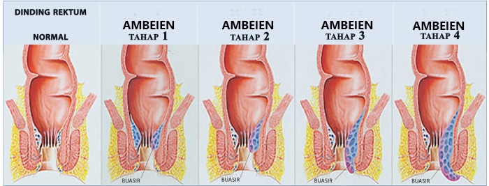 Ambeclear Aman Untuk Ibu Menyusui