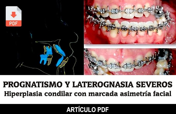 PDF: PROGNATISMO y laterognasia severos, hiperplasia condilar con marcada asimetría facial