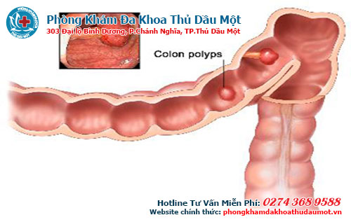 Bị sưng hậu môn có sao không