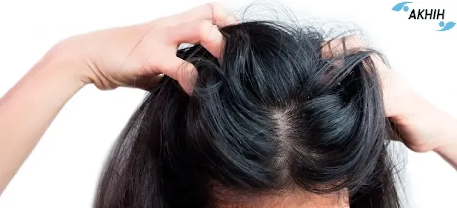 How to Get Rid of Dandruff: 10 Natural Remedies