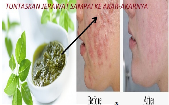 Yuk Dicoba!! Hilangkan Jerawat Sampai Ke Akar Akarnya dengan Bahan Alami Berikut ini