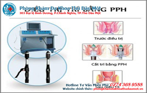 Điều trị bệnh trĩ bằng phương pháp HCPT là gì