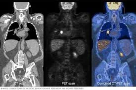 ইবনে সিনা হাসপাতাল ধানমন্ডিতে  PET-CT স্ক্যান টেস্ট