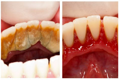 Cách ngăn ngừa vôi răng