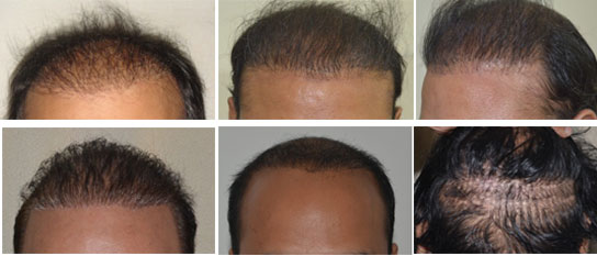 Hair transplant in Jaipur