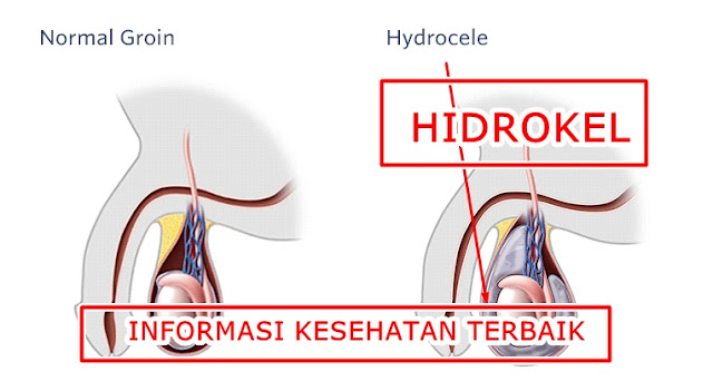 Bahaya, Anjuran dan Pantangan Penyakit Hidrokel