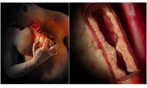 How To Increase Your Chances Of Surviving A Heart Attack