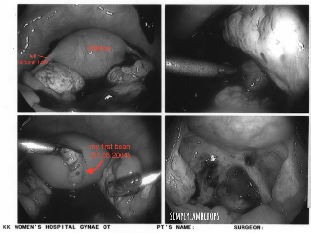 Simply Lambchops and ectopic pregnancy