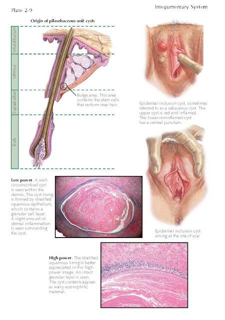 EPIDERMAL INCLUSION CYST