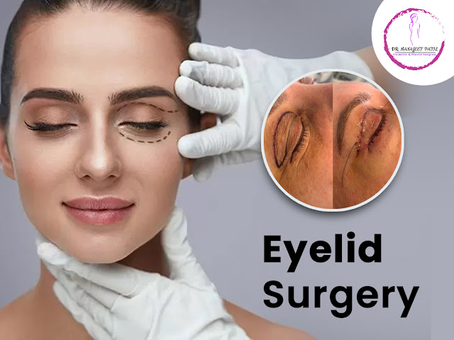 eyelid surgery