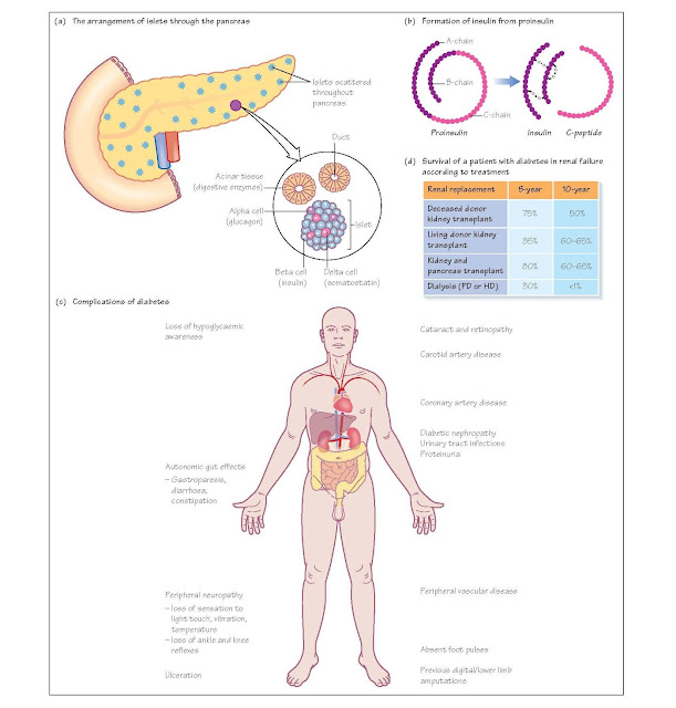 Transplantation For Diabetes Mellitus