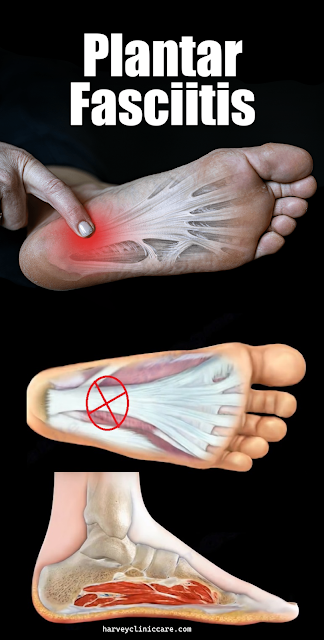 Plantar Fasciitis