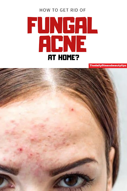 fungal acne or pityrosporum folliculitis treatment