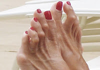 Hammertoes