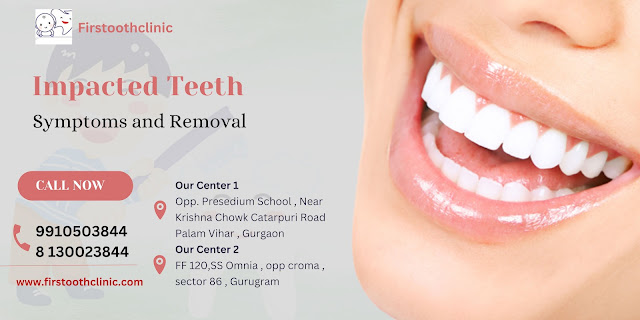 Impacted Teeth-Symptoms and Removal-dental clinic in gurgaon-Firstoothclinic