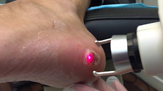 laser wart removal