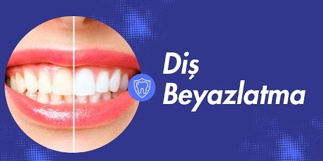 Diş Beyazlatma