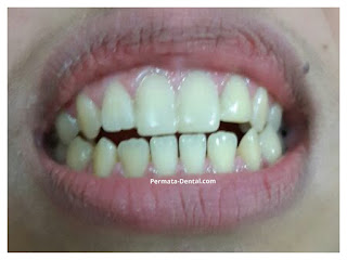 foto, gambar, gigi depan hitam Permata Dental Bali| sebelum dan sesudah gigi hitam diperbaiki di Permata Dental Bali | foto gigi keropos hitam Permata Dental Bali |gigi hitam karena sakit | gigi hitam berlubang di Permata Dental Bali | gigi hitam depan di Permata Dental Bali | gigi hitam bagian belakang | foto gigi hitam yang sudah diperbaiki Permata Dental Bali |  gigi hitam bagian depan| foto gigi keropos dan hitam, foto gigi hitam oleh Permata Dental Bali , Bali Hits, Bali banget, area Bali, Bali  kota, area kampus Bali. veneer gigi hitam Bali | gambar sebelum dan sesudah veneer gigi hitam dan berlubang  veneer gigi hitam Bali | veneer gigi hitam denpasar| veneer gigi hitam nusadua | veneer gigi hitam ngurahrai| veneer gigi hitam badung| veneer gigi hitam jember jimbaran| veneer gigi hitam gatsu| veneer gigi hitam bali | veneer gigi hitam bagus di Permata Dental Bali | veneer gigi hitam baik di Permata Dental Bali | veneer gigi hitam cepat di Permata Dental Bali | veneer gigi hitam murah di Permata Dental Bali | veneer gigi hitam aman di Permata Dental Bali | veneer gigi hitam mudah di Permata Dental Bali | veneer gigi hitam promo Permata Dental Bali | gambar veneer gigi hitam Permata Dental Bali | gambar sebelum dan sesudah veneer gigi hitam dan berlubang Permata Dental Bali | veneer gigi hitam bagus | veneer gigi hitam baik | veneer gigi hitam cepat | veneer gigi hitam murah| veneer gigi hitam aman | veneer gigi hitam mudah  | veneer gigi hitam promo | gambar veneer gigi hitam | gambar sebelum dan sesudah veneer gigi hitam dan berlubang Permata Dental Bali | foto veneer gigi hitam Permata Dental Bali |perbaiki gigi hitam Permata Dental Bali | cara mengatasi gigi hitam Permata Dental Bali | menghilangkan gigi hitam Permata Dental Bali | cara menghilangkan gigi hitam Permata Dental Bali | cara memutihkan  gigi hitam Permata Dental Bali | membantu menghilangkan gigi hitam Permata Dental Bali | perbaiki Permata Dental Bali | harga perbaiki gigi hitam Permata Dental Bali | perbaiki gigi hitam murah  Permata Dental Bali | perbaiki gigi hitam promo Permata Dental Bali | perbaiki gigi hitam bagus Permata Dental Bali | perbaiki gigi hitam  aman Permata Dental Bali | perbaiki gigi hitam cepat  Permata Dental Bali | perbaiki gigi hitam mudah Permata Dental Bali | harga perbaiki gigi hitam mudah Permata Dental Bali | perbaiki gigi hitam Permata Dental Bali |proses perbaiki gigi hitam mudah Permata Dental Bali | foto perbaiki gigi hitam Permata Dental Bali | gambar perbaiki gigi hitam Permata Dental Bali | perbaiki gigi hitam mudah Permata Dental Bali | perbaiki  gigi hitam bali| perbaiki  gigi hitam denpasar  | perbaiki  gigi hitam nusadua| perbaiki  gigi hitam badung| perbaiki  gigi hitam ngurahrai| perbaiki  gigi hitam gatsu| perbaiki  gigi hitam jimbaran| perbaiki  gigi hitam tabanan| perbaiki  gigi hitam