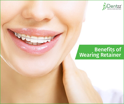 Benefits of Retainer- Dentzz