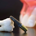 Cấu tạo của một chiếc răng implant nha khoa