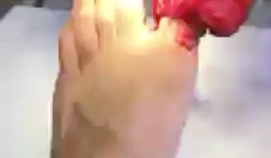 Lutador de MMA sofre corte no dedão e pode ter que amputá-lo; veja foto