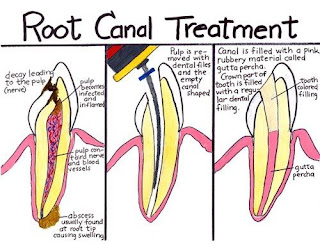 Root waterway treatment must be a standout among the most sensitive dental systems ever. Each time somebody says a visit to the dental specialist; this is the main treatment that will undoubtedly ring a bell. They will either consider root channels or props. It is just as of late that innovation has achieved some different medicines like dental inserts, Invisalign, dental crowns, porcelain polishes and significantly more. Be that as it may, there is just so much that you can do with porcelain polishes to treat a tooth that has a contaminated mash. To come clean, there is nothing that finishes can improve the situation you in such a case. Root channel treatment can do a ton however. 