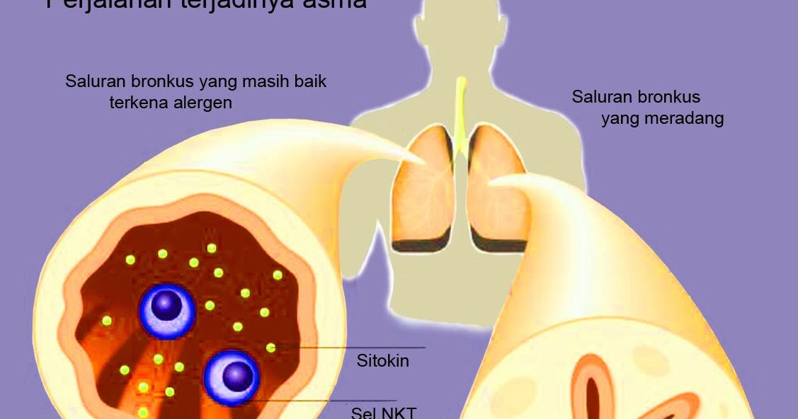 obat penyakit asma tradisional obat alami penderita asma