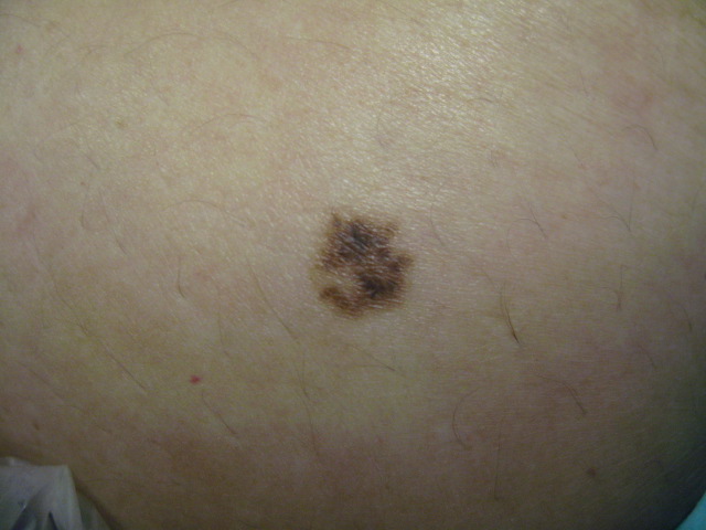 a Melanoma in situ.