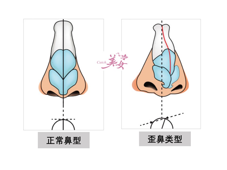 凱奇美女公主日記catch Meinv 男生歪鼻手术 除外观以外功能治疗及歪鼻矫正成功的方法