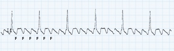 Atrial Flutter (Fluter Atrial) - JANTUNG OKE